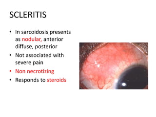 SCLERITIS
• In sarcoidosis presents
as nodular, anterior
diffuse, posterior
• Not associated with
severe pain
• Non necrotizing
• Responds to steroids
 