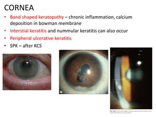 CORNEA
• Band shaped keratopathy – chronic inflammation, calcium
deposition in bowman membrane
• Interstial keratitis and nummular keratitis can also occur
• Peripheral ulcerative keratitis
• SPK – after KCS
 