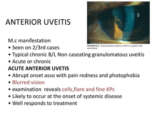 ANTERIOR UVEITIS
M.c manifestation
• Seen on 2/3rd cases
• Typical chronic B/L Non caseating granulomatous uveitis
• Acute or chronic
ACUTE ANTERIOR UVETIS
• Abrupt onset asso with pain redness and photophobia
• Blurred vision
• examination reveals cells,flare and fine KPs
• Likely to occur at the onset of systemic disease
• Well responds to treatment
 