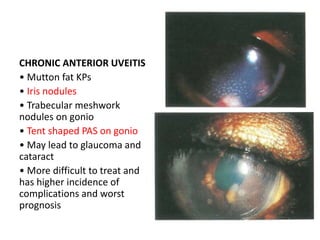 CHRONIC ANTERIOR UVEITIS
• Mutton fat KPs
• Iris nodules
• Trabecular meshwork
nodules on gonio
• Tent shaped PAS on gonio
• May lead to glaucoma and
cataract
• More difficult to treat and
has higher incidence of
complications and worst
prognosis
 