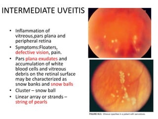 INTERMEDIATE UVEITIS
• Inflammation of
vitreous,pars plana and
peripheral retina
• Symptoms:Floaters,
defective vision, pain.
• Pars plana exudates and
accumulation of white
blood cells and vitreous
debris on the retinal surface
may be characterized as
snow banks and snow balls
• Cluster – snow ball
• Linear array or strands –
string of pearls
 