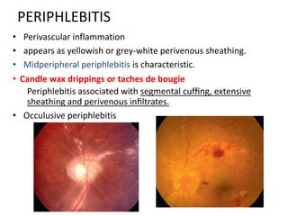 PERIPHLEBITIS
• Perivascular inflammation
• appears as yellowish or grey-white perivenous sheathing.
• Midperipheral periphlebitis is characteristic.
• Candle wax drippings or taches de bougie
Periphlebitis associated with segmental cufﬁng, extensive
sheathing and perivenous inﬁltrates.
• Occulusive periphlebitis
 