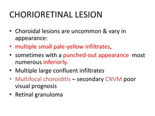 CHORIORETINAL LESION
• Choroidal lesions are uncommon & vary in
appearance:
• multiple small pale-yellow infiltrates,
• sometimes with a punched-out appearance most
numerous inferiorly.
• Multiple large confluent infiltrates
• Multifocal choroiditis – secondary CNVM poor
visual prognosis
• Retinal granuloma
 