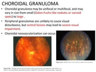 CHOROIDAL GRANULOMA
• Choroidal granuloma may be unifocal or multifocal, and may
vary in size from small (Dalen-Fuchs-like nodules or sarcoid
spots) to large .
• Peripheral granulomas are unlikely to cause visual
disturbance, but central lesions may lead to severe visual
impairment.
• Choroidal neovascularization can occur.
 