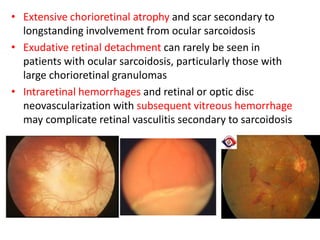 • Extensive chorioretinal atrophy and scar secondary to
longstanding involvement from ocular sarcoidosis
• Exudative retinal detachment can rarely be seen in
patients with ocular sarcoidosis, particularly those with
large chorioretinal granulomas
• Intraretinal hemorrhages and retinal or optic disc
neovascularization with subsequent vitreous hemorrhage
may complicate retinal vasculitis secondary to sarcoidosis
 