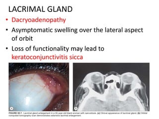 LACRIMAL GLAND
• Dacryoadenopathy
• Asymptomatic swelling over the lateral aspect
of orbit
• Loss of functionality may lead to
keratoconjunctivitis sicca
 