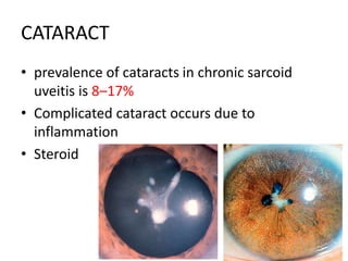 CATARACT
• prevalence of cataracts in chronic sarcoid
uveitis is 8–17%
• Complicated cataract occurs due to
inflammation
• Steroid
 