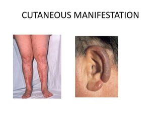 CUTANEOUS MANIFESTATION
 