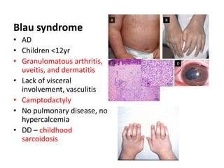 Blau syndrome
• AD
• Children <12yr
• Granulomatous arthritis,
uveitis, and dermatitis
• Lack of visceral
involvement, vasculitis
• Camptodactyly
• No pulmonary disease, no
hypercalcemia
• DD – childhood
sarcoidosis
 