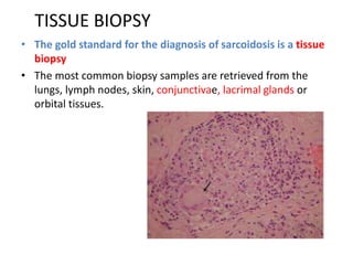 TISSUE BIOPSY
• The gold standard for the diagnosis of sarcoidosis is a tissue
biopsy
• The most common biopsy samples are retrieved from the
lungs, lymph nodes, skin, conjunctivae, lacrimal glands or
orbital tissues.
 