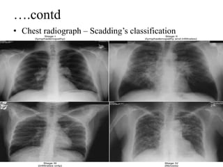 Scadding Radiological Classification Sarcoidosis | PPT