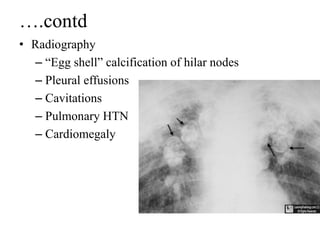 Sarcoidosis | PPT