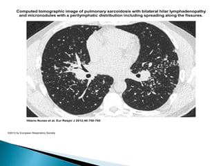 Computed tomographic image of pulmonary sarcoidosis with bilateral hilar lymphadenopathy
and micronodules with a perilymphatic distribution including spreading along the fissures.
Hilario Nunes et al. Eur Respir J 2012;40:750-765
©2012 by European Respiratory Society
 