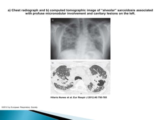 a) Chest radiograph and b) computed tomographic image of “alveolar” sarcoidosis associated
with profuse micronodular involvement and cavitary lesions on the left.
Hilario Nunes et al. Eur Respir J 2012;40:750-765
©2012 by European Respiratory Society
 