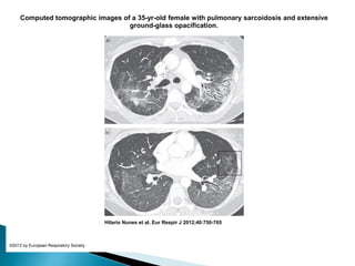 Computed tomographic images of a 35-yr-old female with pulmonary sarcoidosis and extensive
ground-glass opacification.
Hilario Nunes et al. Eur Respir J 2012;40:750-765
©2012 by European Respiratory Society
 