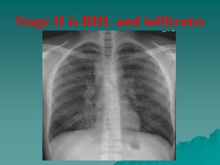 Stage II is BHL and infiltrates
 