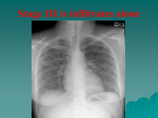 Stage III is infiltrates alone
 