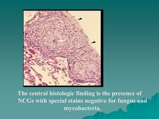 The central histologic finding is the presence of
NCGs with special stains negative for fungus and
mycobacteria.
 