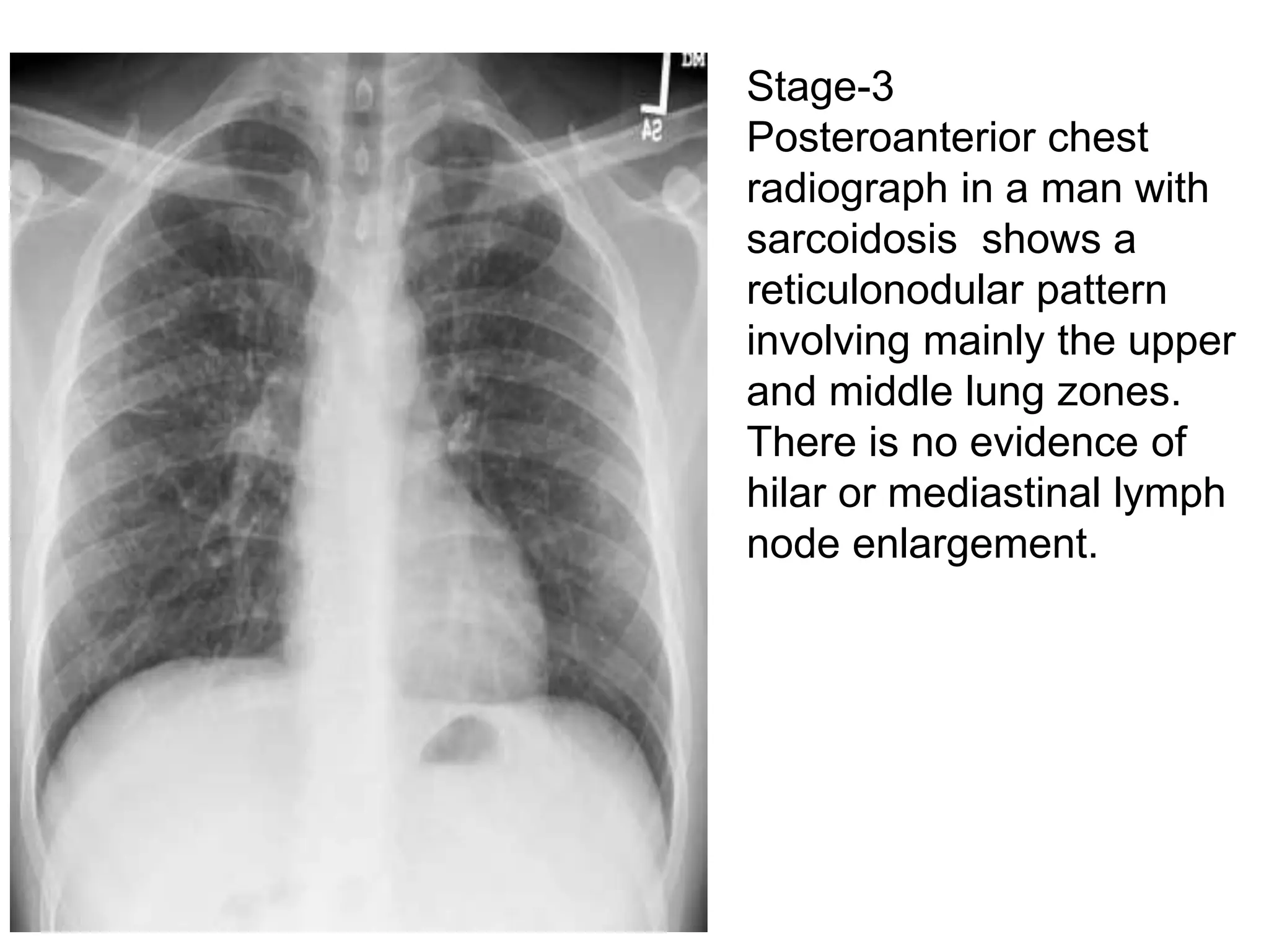 sarcoidosis chest xray and hrct findings | PPTX