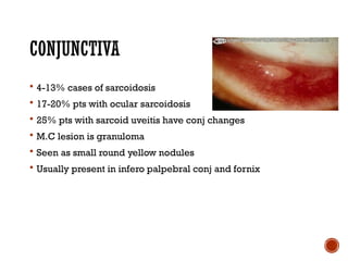 Comprehensive Overview of Ocular Sarcoidosis and Fuchs Uveitis Syndrome ...