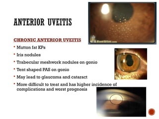 Comprehensive Overview of Ocular Sarcoidosis and Fuchs Uveitis Syndrome ...
