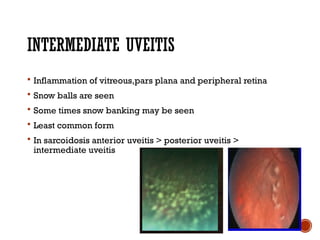 Comprehensive Overview of Ocular Sarcoidosis and Fuchs Uveitis Syndrome ...