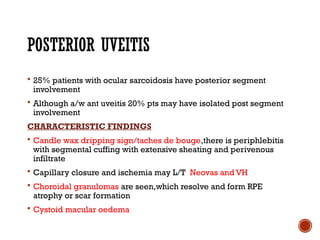 Comprehensive Overview of Ocular Sarcoidosis and Fuchs Uveitis Syndrome ...