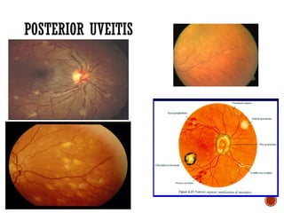Comprehensive Overview of Ocular Sarcoidosis and Fuchs Uveitis Syndrome ...