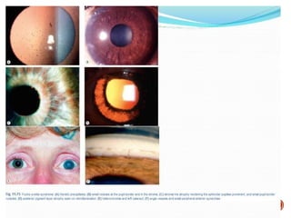Comprehensive Overview of Ocular Sarcoidosis and Fuchs Uveitis Syndrome ...