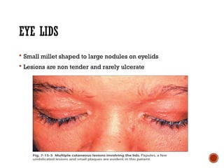 Comprehensive Overview of Ocular Sarcoidosis and Fuchs Uveitis Syndrome ...