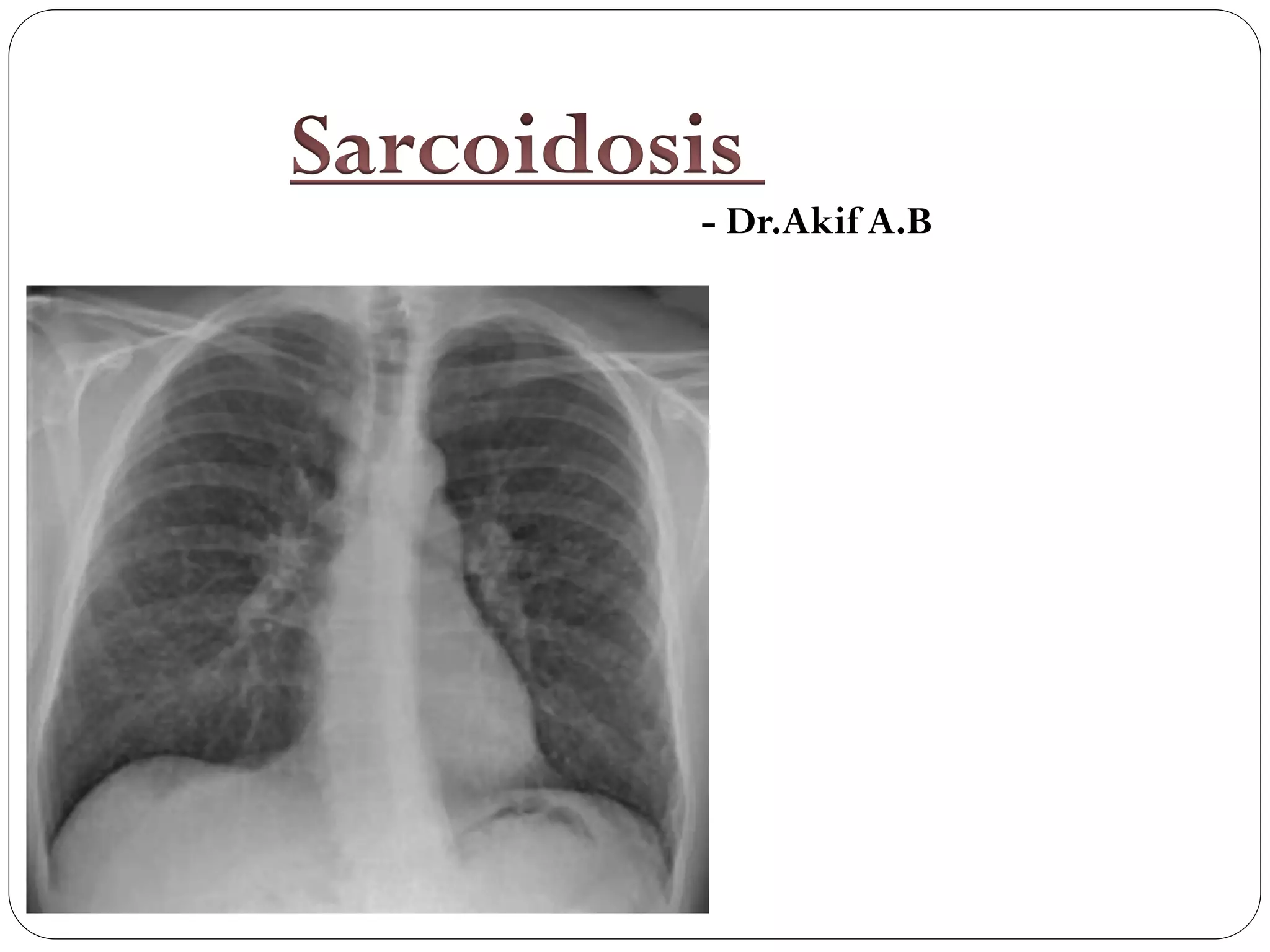 Sarcoidosis | PDF
