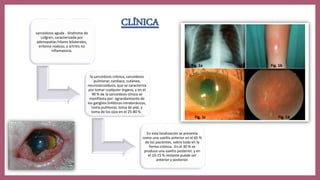 CLÍNICA
sarcoidosis aguda - Síndrome de
Lofgren, caracterizada por
adenopatías hilares bilaterales,
eritema nodoso, y artritis no
inflamatoria.
la sarcoidosis crónica, sarcoidosis
pulmonar, cardiaca, cutánea,
neurosarcoidosis, que se caracteriza
por tomar cualquier órgano, y en el
90 % de la sarcoidosis clínica se
manifiesta por: agrandamiento de
los ganglios linfáticos intratorácicos,
toma pulmonar, toma de piel, y
toma de los ojos en el 25-80 %.
En esta localización se presenta
como una uveítis anterior en el 65 %
de los pacientes, sobre todo en la
forma crónica. En el 30 % se
produce una uveítis posterior, y en
el 10-15 % restante puede ser
anterior y posterior.
 