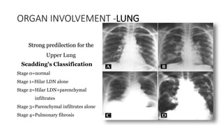 Scadding Radiological Classification Sarcoidosis and IgG4 | PPTX