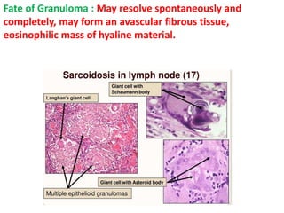 Fate of Granuloma : May resolve spontaneously and
completely, may form an avascular fibrous tissue,
eosinophilic mass of hyaline material.
 