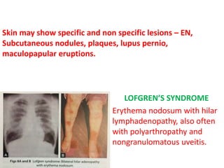 Skin may show specific and non specific lesions – EN,
Subcutaneous nodules, plaques, lupus pernio,
maculopapular eruptions.
LOFGREN’S SYNDROME
Erythema nodosum with hilar
lymphadenopathy, also often
with polyarthropathy and
nongranulomatous uveitis.
 