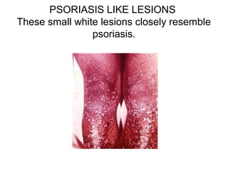 PSORIASIS LIKE LESIONS
These small white lesions closely resemble
psoriasis.
 