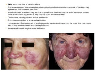 ✕ Skin: about one third of patients which
• Erythema nodosum: they are erythematous painful nodules in the anterior surface of the legs, they
represent a subcutaneous vasculitis.
• Maculopapulous eruptions: they are due to granulomas itself and may be up to 3cm with a plateau
surface and of wax appearance, they may be found all over the body.
• Dischromias: usually painless and of a violate tin.
• Subcutanous nodules: in trunk and extrimities
• Lupus pernio: it forms complex of shining cyanotic harden lessions around the nose, libs, checks and
ears, it may erode to bones and cartilages around.
• It may develop over surgical scars and tattoo.
 