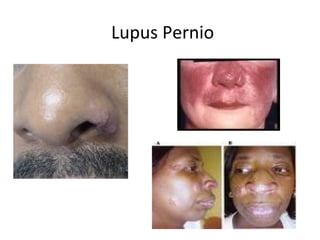 Lupus Pernio
 