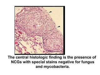 The central histologic finding is the presence of
NCGs with special stains negative for fungus
and mycobacteria.
 