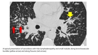 A typical presentation of sarcoidosis with hilar lymphadenopathy and small nodules along bronchovascular
bundles (yellow arrow) and along fissures (red arrows)
 