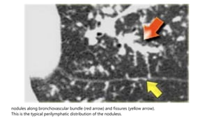 nodules along bronchovascular bundle (red arrow) and fissures (yellow arrow).
This is the typical perilymphatic distribution of the noduless.
 