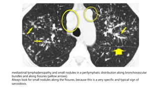 mediastinal lymphadenopathy and small nodules in a perilymphatic distribution along bronchovascular
bundles and along fissures (yellow arrows).
Always look for small nodules along the fissures, because this is a very specific and typical sign of
sarcoidosis.
 