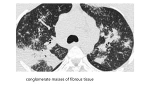 conglomerate masses of fibrous tissue
 
