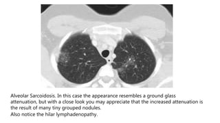 Alveolar Sarcoidosis. In this case the appearance resembles a ground glass
attenuation, but with a close look you may appreciate that the increased attenuation is
the result of many tiny grouped nodules.
Also notice the hilar lymphadenopathy.
 