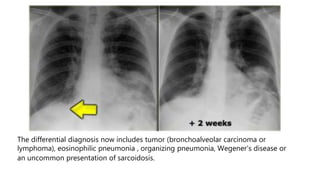 The differential diagnosis now includes tumor (bronchoalveolar carcinoma or
lymphoma), eosinophilic pneumonia , organizing pneumonia, Wegener's disease or
an uncommon presentation of sarcoidosis.
 