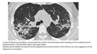 a case of fibrosing sarcoidosis, showing fibrosis, traction bronchiectases and crowding of the involved bronchi,
predominantly in the perihilar region and upper lobes.
Nodular abnormalities are absent, but the appearance and the location of the fibrosis are very suggestive of the
diagnosis of sarcoidosis.
 