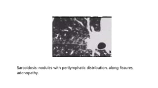 Sarcoidosis: nodules with perilymphatic distribution, along fissures,
adenopathy.
 