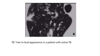 TB: Tree-in-bud appearance in a patient with active TB.
 