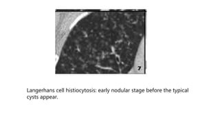 Langerhans cell histiocytosis: early nodular stage before the typical
cysts appear.
 