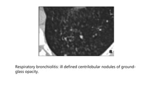 Respiratory bronchiolitis: ill defined centrilobular nodules of ground-
glass opacity.
 